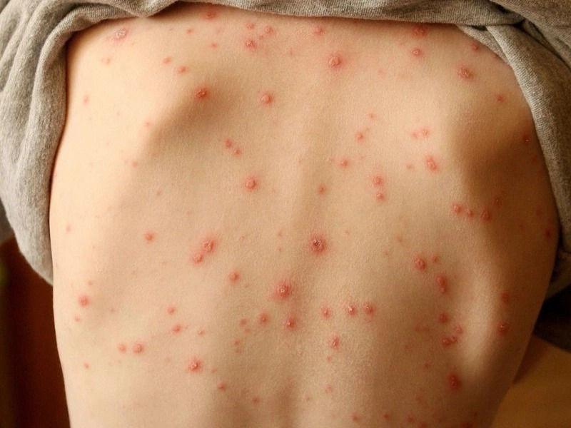 bị mối cắn có sao không